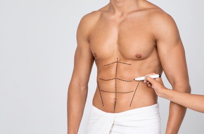 Six Pack Surgery