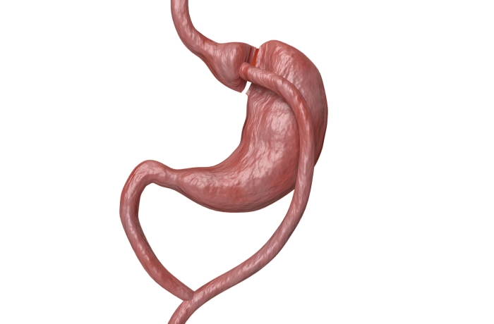 shape of stomach after gastric bypass