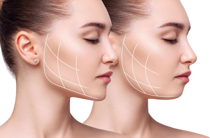 chin augmentation