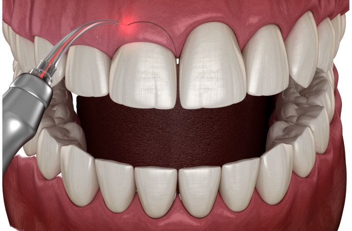 gum contouring