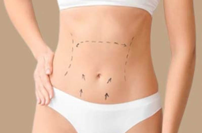 drawings for tummy tuck