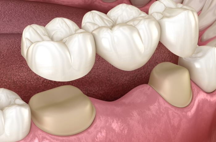 Dental Bridge