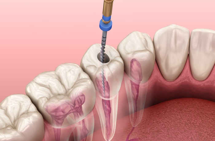 Root Canal Treatment