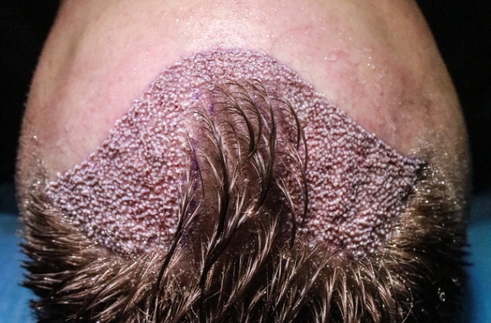 DHI Hair Transplantation