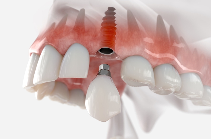 single dental implant on upper jaw
