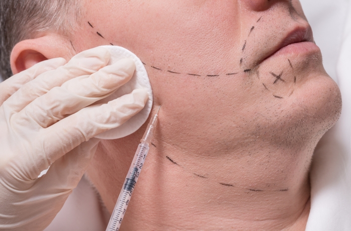 injection to mans face for beard transplantation