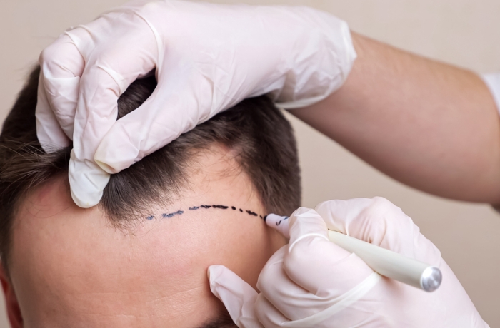 marking hairline on sides before transplant procedure