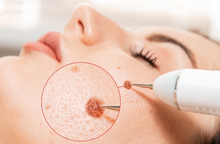 touching mole on face with medical device