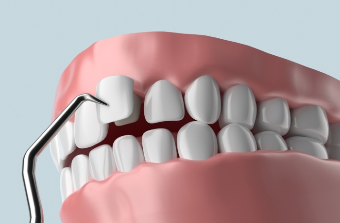 Dental Veneer