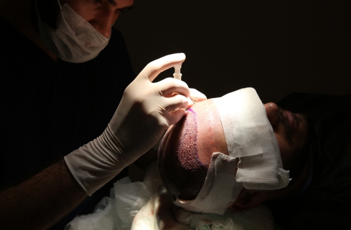 application of hair transplantation