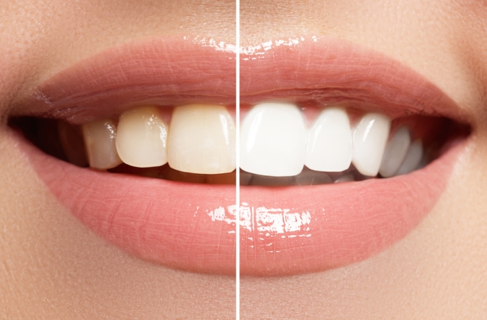 yellow and white teeth side by side